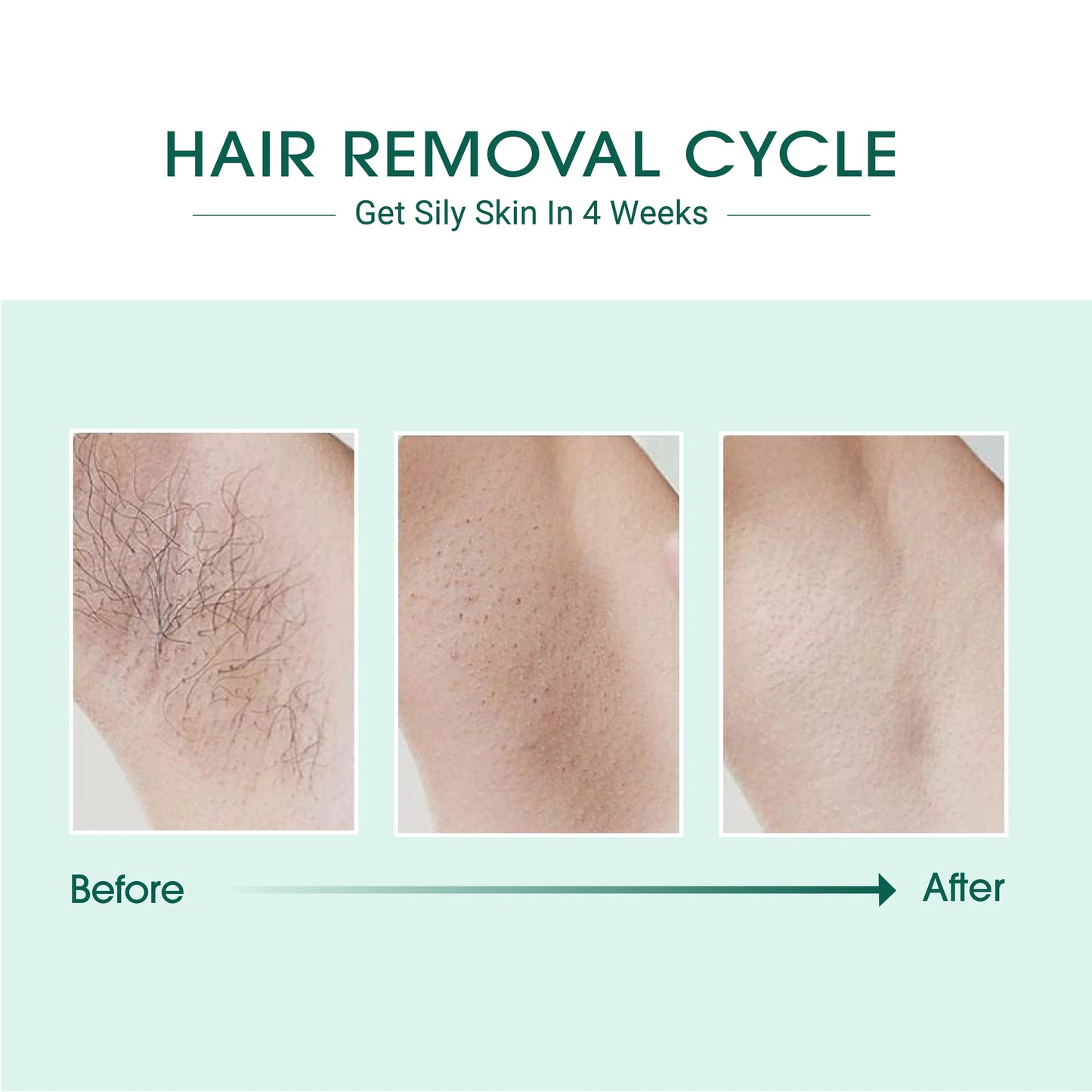 Smooth Glow Laser Hair Removal Device